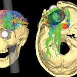 Lo “strano” caso di Phineas Gage