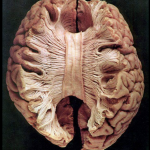 Pazienti split brain
